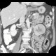 Renal carcinoma, Grawitz tumour: CT - Computed tomography